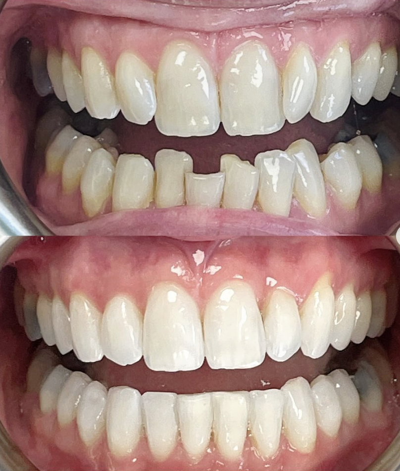 Invisalign® clear aligners at Opaline, Windsor